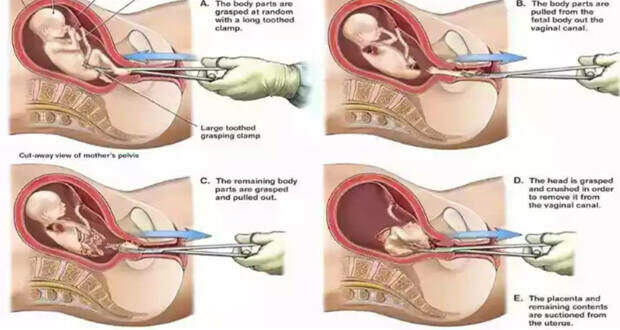 dismemberment abortion