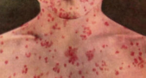 asbury measles