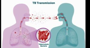 tuberculosis