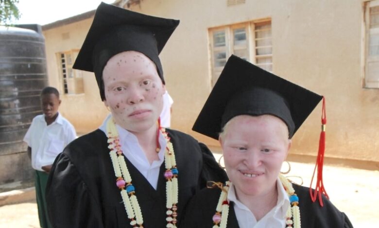 albinism